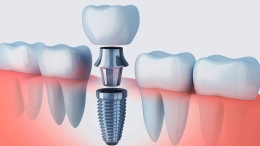 Mejora tu sonrisa con implantes dentales