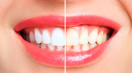 Comparativa de blanqueamiento dental