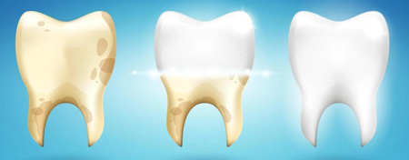 Proceso de blanqueamiento dental