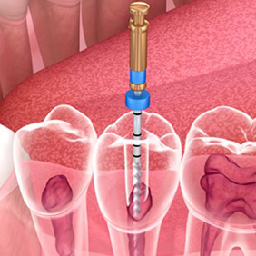 Endodoncia