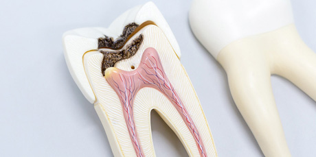 Endodoncia caries