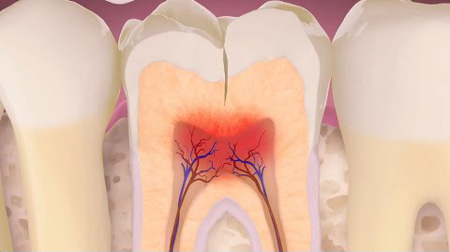 Diente fracturado