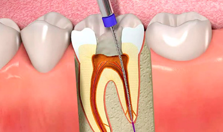 Tratamientos de endodoncia