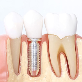 Implantes Dentales