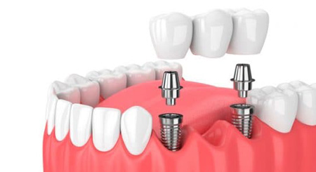Detalle de implante dental
