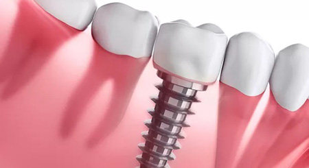 Detalle de implante dental