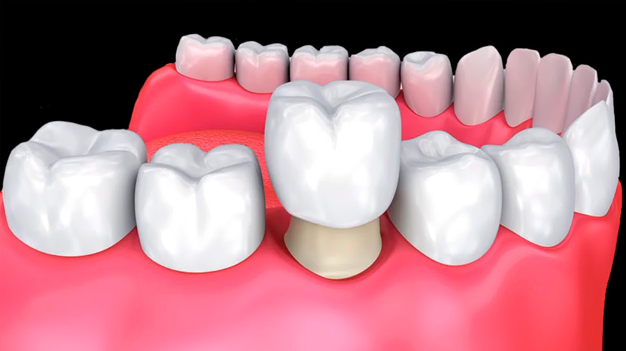 La importancia de colocarse una corona después de una endodoncia