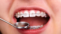 Ortodoncia infantil