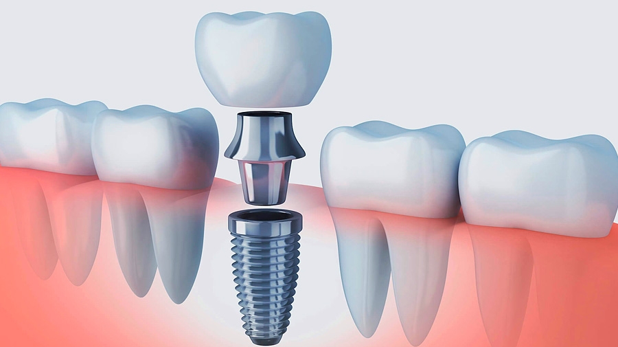 Mejora tu sonrisa con implantes dentales
