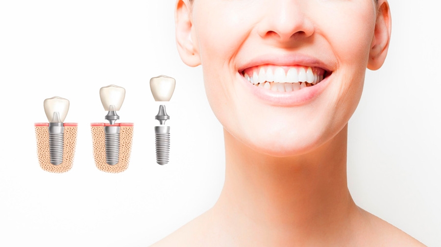 Dieta para cuidar tus implantes dentales