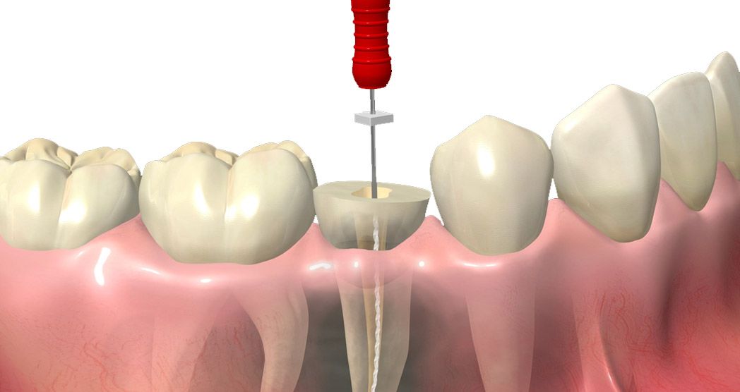 Tratamientos Endodoncia