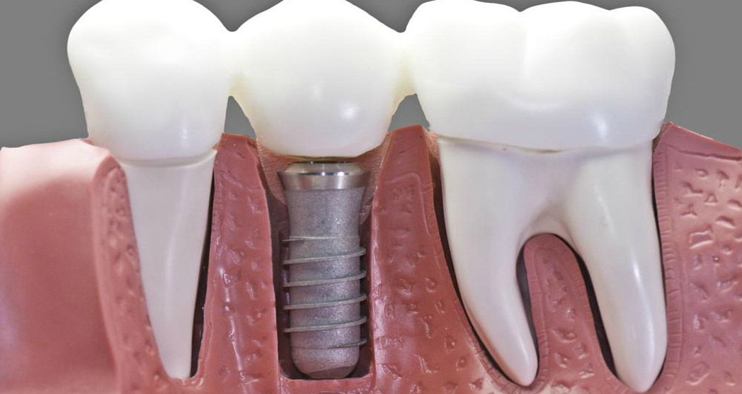 Implantes Dentales